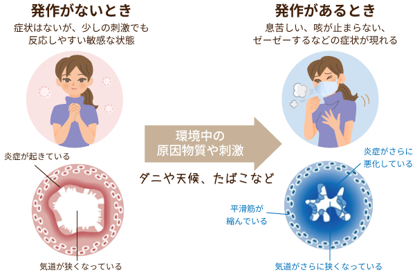 そのせき、ぜんそくかもしれません